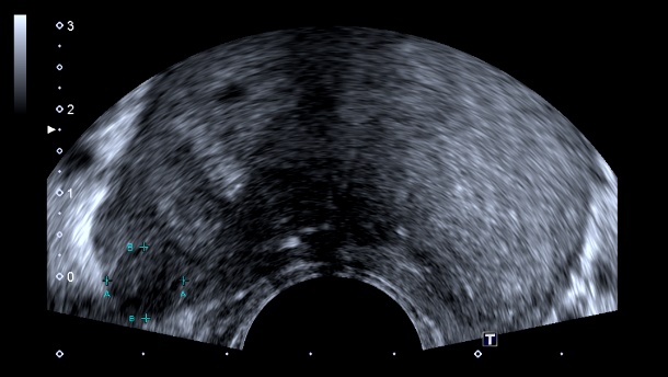 adenocarcinoma da prostata gleason 9mm